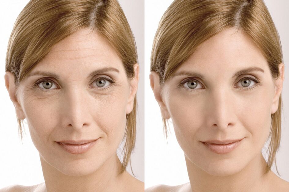 Experiencia no uso antes e despois de usar a crema intenskin de Milana